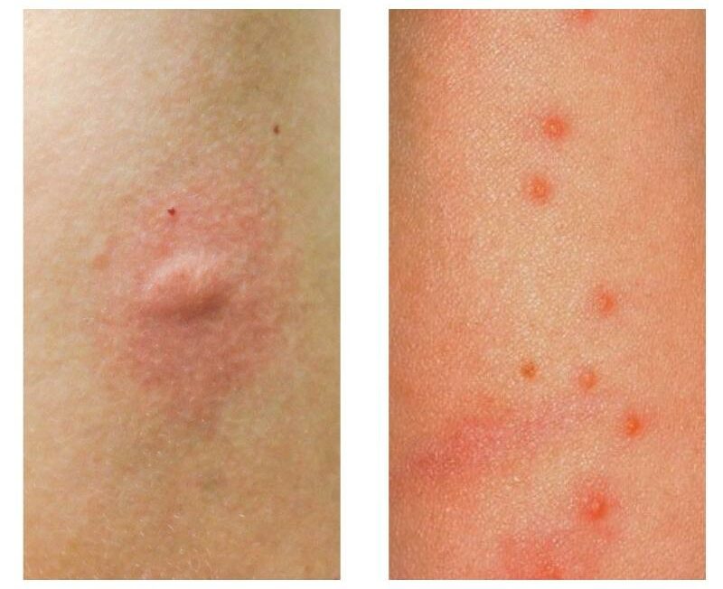 Picadura de mosquito y picadura de pulga